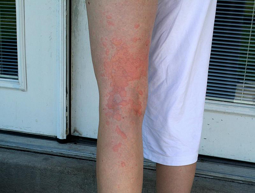 Urticaria rash on legs